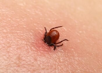 Kene Isırığı Sonrası İşitme Kaybı: Bir Vaka Raporu